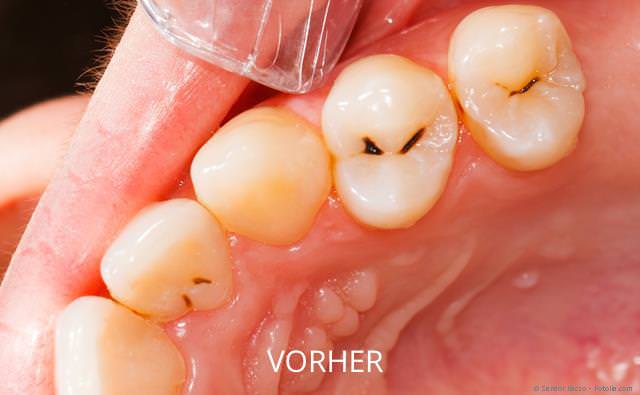 310_kons_komposit_vorher_fotolia_Sandor_Kacso_640x395-1920w