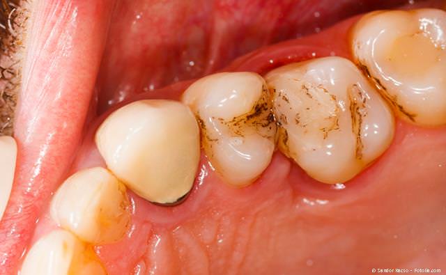 Grau sich zahn verfärbt Graues Zahnfleisch,