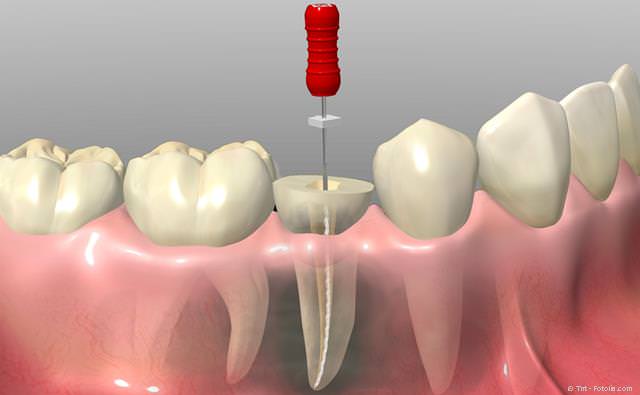 Schematische Darstellung einer Wurzelbehandlung