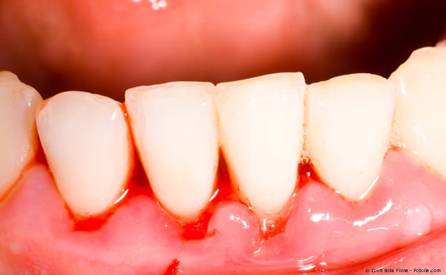 Entzündetes und blutendes Zahnfleisch bei einer Parodontitis