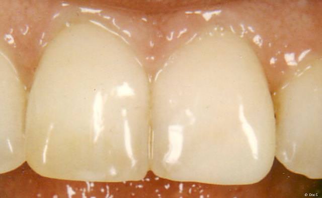 Derselbe Zahn mit einem Eckenaufbau aus Komposit