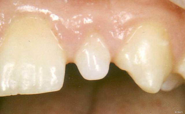 Zahn mit fehlender Schaufelform