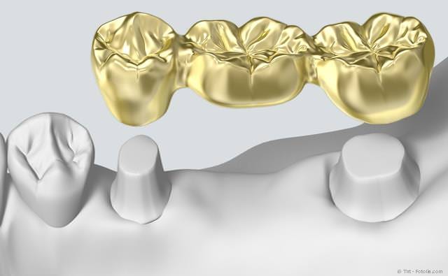 Für eine Zahnbrücke müssten die Nachbarzähne abgeschliffen werden. Bei Implantaten ist das nicht erforderlich.