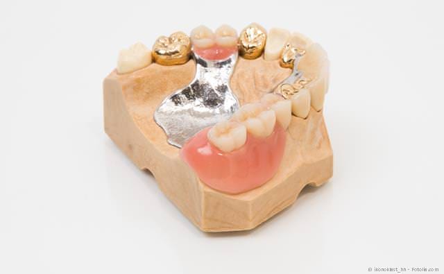 Wenn viele Zähne fehlen, können mit Implantaten herausnehmbare Teilprothesen vermieden werden.