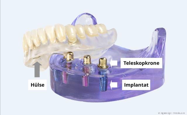 Mit nur wenigen Implantaten können Totalprothesen wieder einen sicheren Halt bekommen.