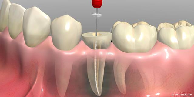 WURZELBEHANDLUNG - Zähne mit modernen Behandlungs-Methoden erhalten und Kosten für Zahnersatz und Implantate sparen